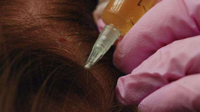 Plasma treatment, plasmolifting or PRP method point the introduction of the patient's own plasma enriched with platelets, in the problem areas of the skin.