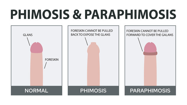 Phimosis and Paraphimosis Vector Illustration