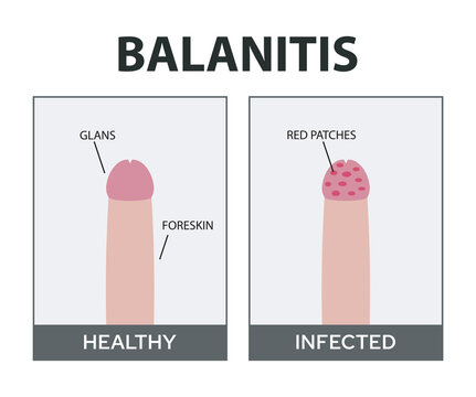 Candida Balanitis Vector Illustration. Male Yeast Infection.