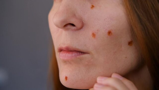 Woman with burns on her face after removing moles cosmetic aesthetic skin procedure. footage