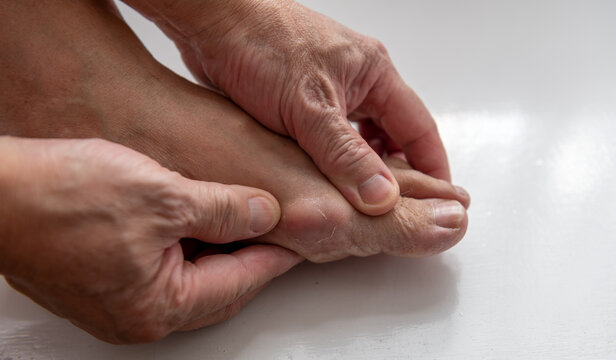 A person suffering from gout pain in the toe joint.