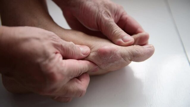A person suffering from gout pain in the toe joint.