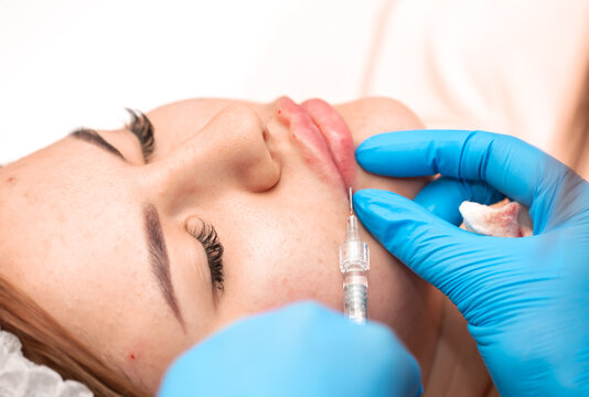 Lip Augmentation. Beautician Injects Hyaluronic Acid Into The Lips Of A Girl With A Syringe. The Cosmetologist Doctor Performs The Procedure In The Cosmetology Office. Plastic Surgery.