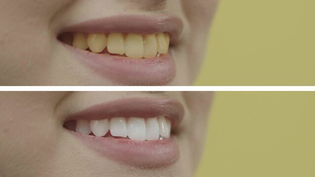 Professional teeth whitening. Close-up image of the teeth of a happy young patient enjoying her white smile, which was previously ugly and unkempt. Image before after