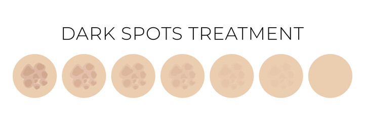 Dark Spots Treatment Isolated Illustration with Whitening or Fading Steps