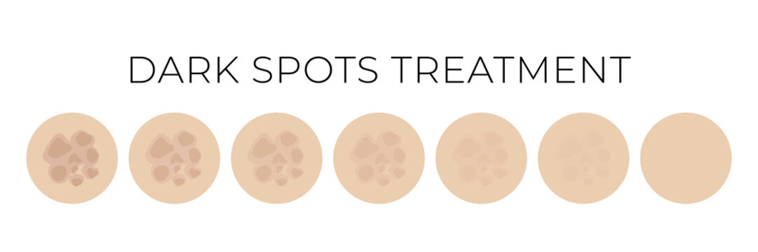 Dark Spots Treatment Isolated Illustration with Whitening or Fading Steps
