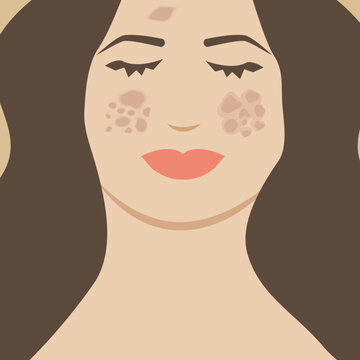 Woman with Melasma on her Face. Illustration of Person with Dark Spots Skin Pigmentation