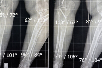 Plain x ray long film standing position showing both legs with bilateral metaphyseal genu varum, previous epiphysiodesis, left distal femur valgus and left medial tibial plateau depression