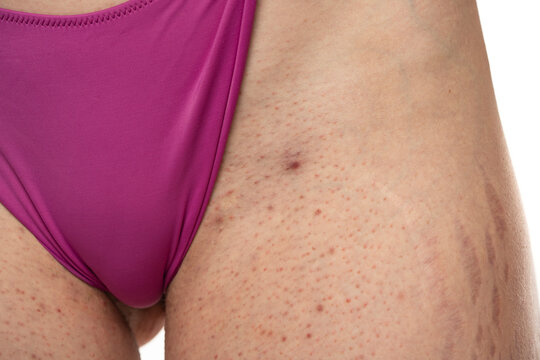 Part of the female body with skin waxing problems on bikini area. Skin infection, boil. Carbuncle.