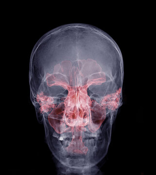 Skull x-ray image fusion with paranasal sinuses 3D
