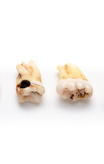 Set of teeth with caries on a white background. Wisdom teeth removed. Sick human teeth.