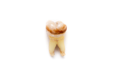 Close-up of a tooth with caries isolated on a white background. Removed wisdom teeth. Sick human teeth.
