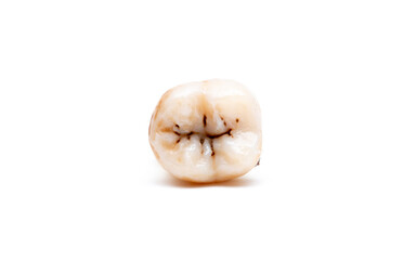 Close-up of a tooth with caries isolated on a white background. Removed wisdom teeth. Sick human teeth.