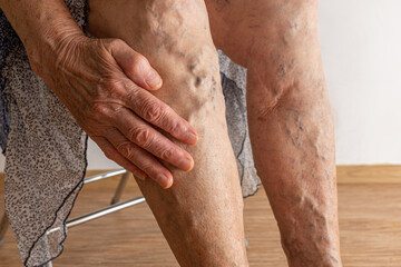 Unrecognizable senior woman hand show bare legs with varicose veins inflammation. Checking health...