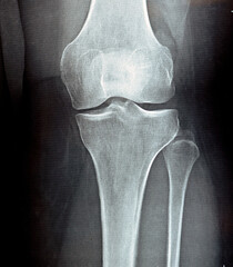plain x ray on knee joint showing joint space narrowing and Subchondral Sclerosis on medial...