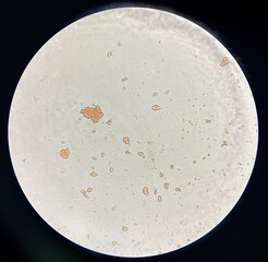 Red blood cell agglutination Crossmatching Incompatible donor.
