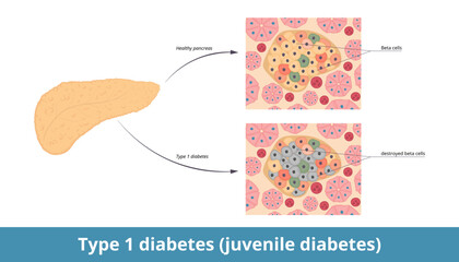Type 1 diabetes (juvenile diabetes).	Diabetes mellitus type 1 originates when pancreatic beta cells are destroyed. Destructed β-cells in pancreas by the immune system and healthy pancreatic tissue. - obrazy, fototapety, plakaty