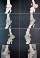 CT angiography of the left knee 3D view showing patent popliteal artery and its bifurcations tibial...