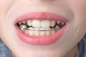 The boy wears a dental plate on his lower jaw. - obrazy, fototapety, plakaty
