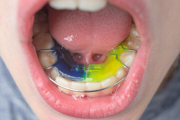 The boy wears a dental plate on his lower jaw.