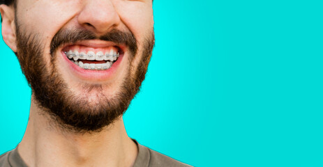 Close-up of a laughing Latin and Hispanic young man with beard showing his orthodontic treatment....