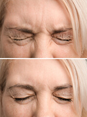 face of an elderly woman wrinkles face before and after procedures