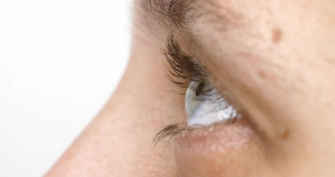 woman eye with corneal dystrophy, keratoconus, thinning of the cornea High quality 4k footage