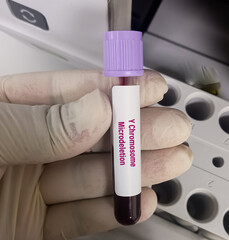 Blood sample for Y chromosome microdeletion test to identifying missing genes in Y chromosome which...