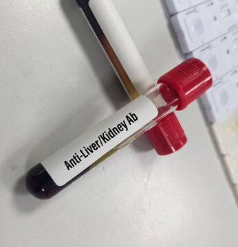 Blood sample for Anti-Liver Kidney(LKM) ab test, diagnosis for autoimmune hepatitis.