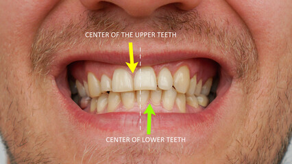 Stomatology, orthodontics. Displacement of the midline of the teeth. Crooked teeth