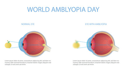 World Amblyopia Day-October 15. Eye with normal vision and eye with amblyopia.