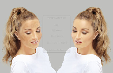 Dark spots, freckles,hyperpigmentation(melasma or chloasma),concept - skin lightening, skin whitening, fruit acids,AHA, Skin Brightening