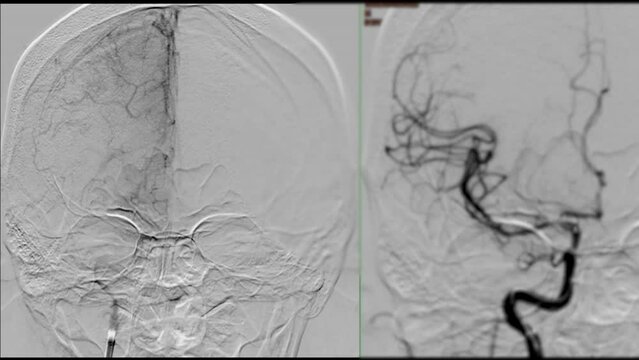 Cerebral angiography  from Fluoroscopy in intervention radiology  showing cerebral artery for diagnosis cerebral artery aneurysm.