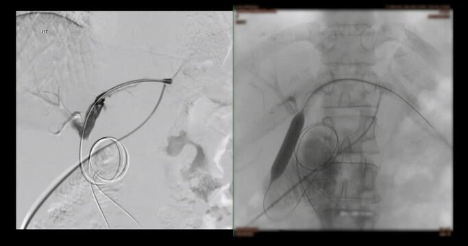 Percutaneous Transhepatic Biliary Drainage (PTBD) is a medical procedure for diagnosis or treatment of a bile duct obstruction.