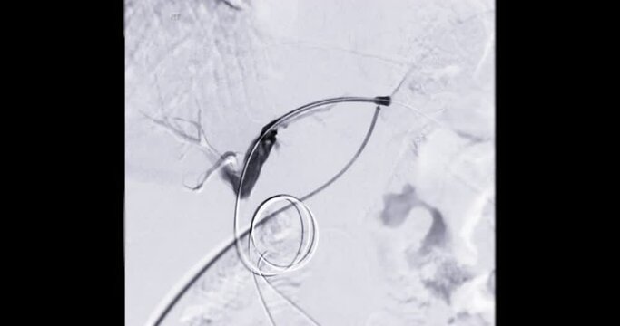 Percutaneous Transhepatic Biliary Drainage (PTBD) is a medical procedure for diagnosis or treatment of a bile duct obstruction.