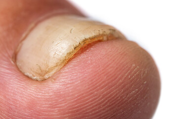Toe nail with psoriasis and healthy toe nails, Psoriatic nail, close-up.