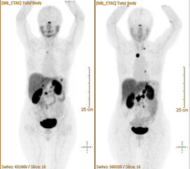 Pet bt ct scan or nuclear scan image of a patient showing normal skeleton of the whole body,...