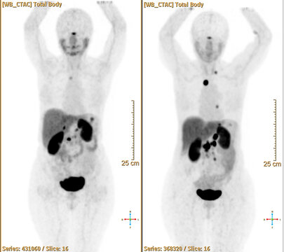 Pet Bt Ct Scan Or Nuclear Scan Image Of A Patient Showing Normal Skeleton Of The Whole Body