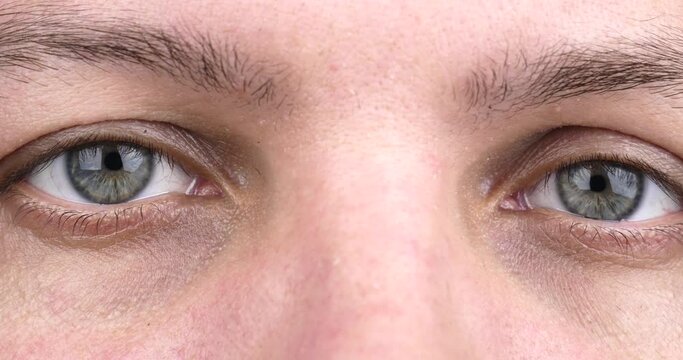 male eyes close up, keratoconus corneal disease. High quality 4k footage