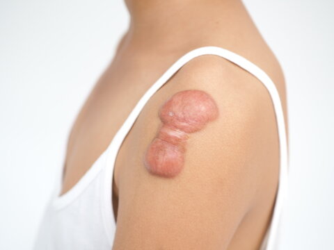 Keloid scar of skin shoulder kid girl case of tissue forms over the wound to repair treatment of laser to reduce size. 