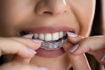 Clear Aligner Dental Night Guard