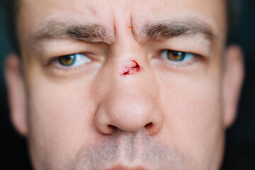 close-up. bloody abrasion on the bridge of the nose of a man after a blow. 