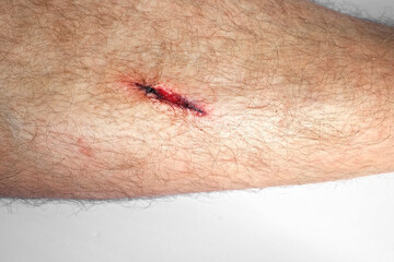 The Wound on a Leg of Young Man. Close Up. Open Red Wound, flows blood, Deep Cut, Dehiscence on...