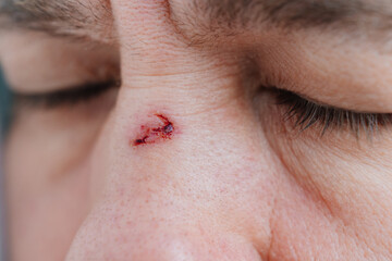 close-up. bloody abrasion on the bridge of the nose of a man after a blow. 