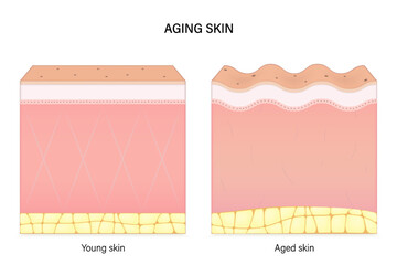 Aging skin. Comparison of young and aged skin. Facial skin problems. Vector for advertising about beauty and medical treatment. - obrazy, fototapety, plakaty