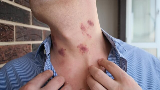 Bruises from hickeys on a man's neck, closeup
