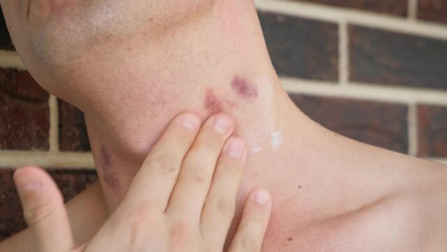 Man applying cream or remedy for bruises on his neck, close-up