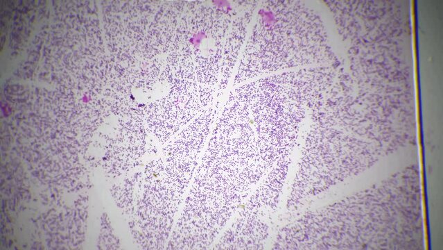 Smear of human blood under microscope with 40 times magnification on bright field. Erythrocytes and monocytes educated in medical lab. Studying hematology for helping people health. Immune system