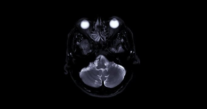 MRI of the brain in axial T2 Fat suppression showing anatomy of the brain.