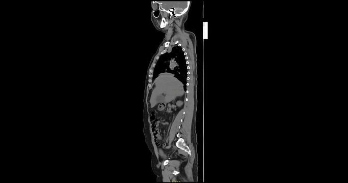 CT myelography with whole spine sagittal view.